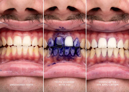 HiSmile V34 Teeth Whitening