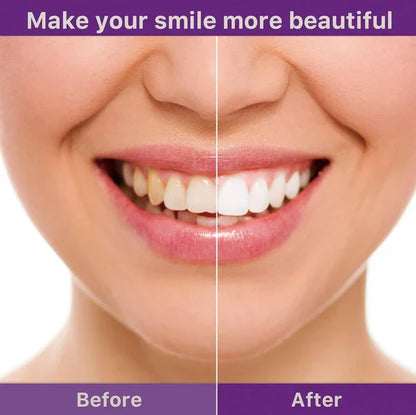 HiSmile V34 Teeth Whitening